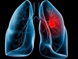 Điều trị ung thư phổi bằng tế bào gốc thử nghiệm lần đầu tiên